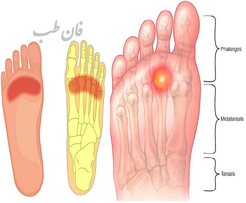 درمان متاتارسالژی, علت درد پنجه پا, درمان درد پنجه پا در طب سنتی,متاتارسالژی چیست,درمان درد کف پا,درد کف پا نشانه چیست؟,symptoms metatarsalgia causes,بیماری درد کف پا,
