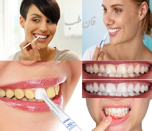 مزایای استفاده از قلم سفید کننده ی دندان, روش استفاده از لاک سفید کننده ی دندان,لاک سفید کننده دندان چیست,دندان,دندان سفید,tooth whitening varnish,
