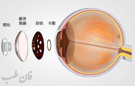   ایمپلنت مصنوعی,قرنیه مصنوعی چشم,درمان آسیبهای شدید چشم با ایمپلنت,ایمپلنت مصنوعی برای درمان چشم های آسیب دیده,ایمپلنت مصنوعی,ایمپلنت,ایمپلنت چیست؟,ایمپلنت چشم,ایمپلنت چشم در چین,درمان آسیب چشم,آسیب های چشم را با ایمپلنت درمان کنید,ایمپلنت درمانی چشم,eye implant,