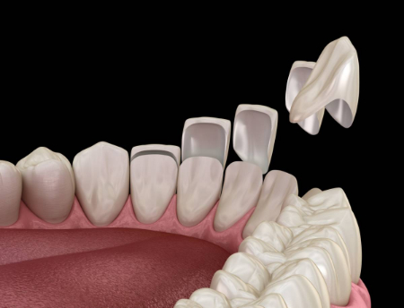 افتادن روکش دندان, علت افتادن روکش دندان, افتادن روکش های دندان به دلایل مختلفی رخ می دهد 
