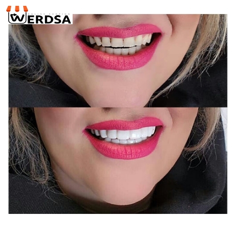لمینت متحرک دندان دو فک snap on smile کد 1496